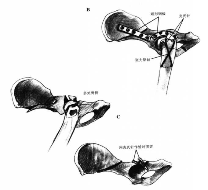 矫形钢板固定术 蜜桃成品人视频入口