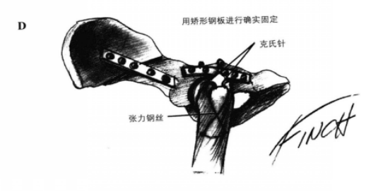 矫形钢板固定术 蜜桃成品人视频入口