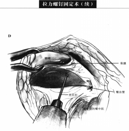 拉力螺钉固定术 蜜桃成品人视频入口