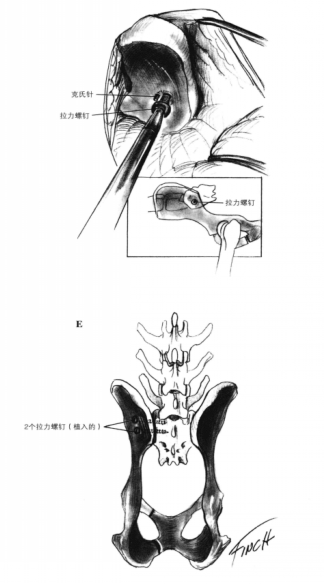 拉力螺钉固定术 蜜桃成品人视频入口