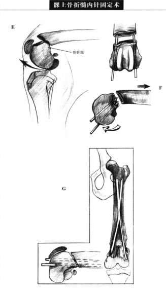 髁上骨折髓内针固定术 蜜桃成品人视频入口