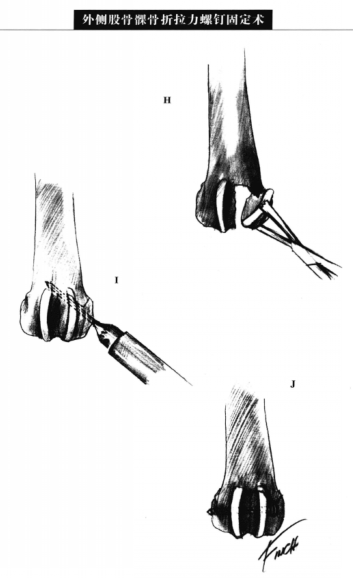 外侧股骨髁骨折拉力螺钉固定术 蜜桃成品人视频入口