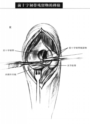 前十字韧带残留物的移除 蜜桃成品人视频入口
