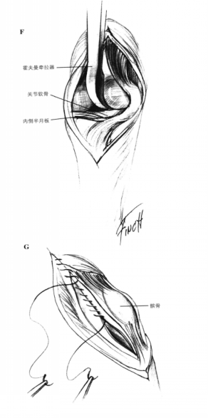 前十字韧带残留物的移除 蜜桃成品人视频入口