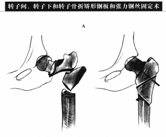 转子间、转子下和转子骨折矫形钢板和张力钢丝固定术 蜜桃成品人视频入口