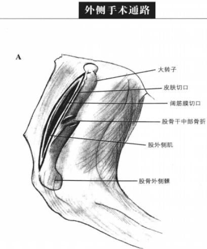 外侧手术通路 蜜桃成品人视频入口