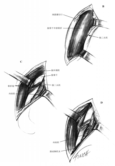 外侧手术通路 蜜桃成品人视频入口